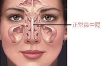 鼻中隔偏曲有哪些发病原因