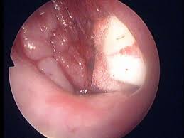 腺样体肥大基本症状是什么