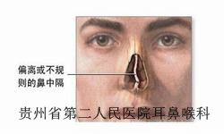 鼻中隔偏曲典型症状是什么
