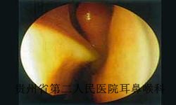 鼻中隔偏曲的危害究竟有哪些