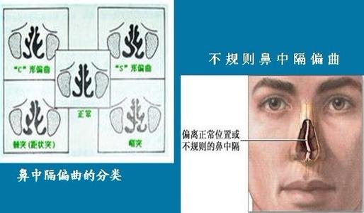导致鼻中隔偏曲的原因是什么