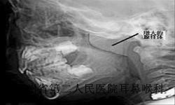 腺样体肥大有什么危害