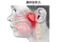 小儿腺样体肥大的危害