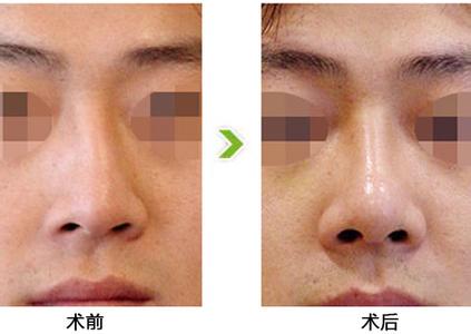 治疗鼻中隔偏曲要多少钱