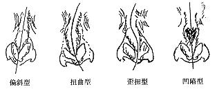 鼻中隔偏曲的危害具体表现