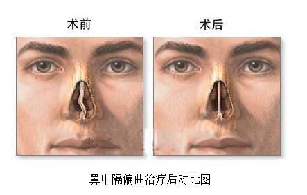 贵阳治疗鼻中隔偏曲医院哪个好