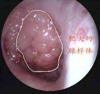 腺样体肥大都有哪些症状