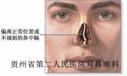 鼻中隔偏曲的常见诱因有什么