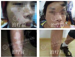 国际白癜风临床治疗较先进技术——【白癜风】Recell细胞再生术 国际白癜风临床治疗较先进技术——【白癜风】Recell细胞再生术