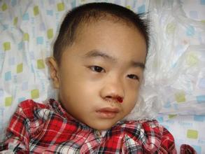 鼻出血的局部病因