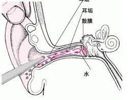 中耳炎的预防措施