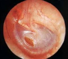 中耳炎会出现的症状