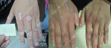 白癜风治疗方法 白癜风治疗方法