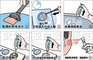 白癜风治疗方法 白癜风治疗方法