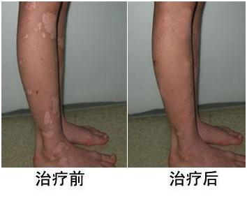 白癜风治疗有效的表现