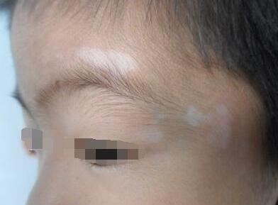 儿童患了白癜风有哪些危害