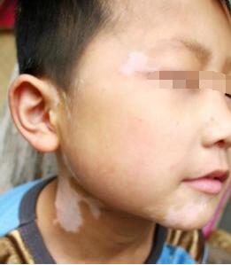 儿童面部白癜风究竟怎么处理好