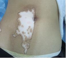 白癜风会有哪些常见表现