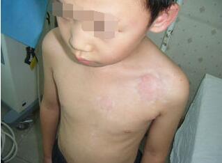 小孩得了白癜风要怎么办