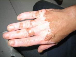 怎么防止手部白癜风的发作