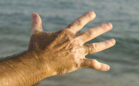 白癜风夏天在生活中要注意什么