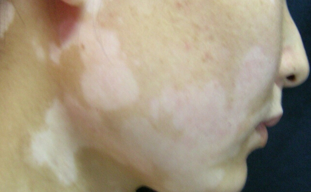 治疗面部白癜风要注意什么