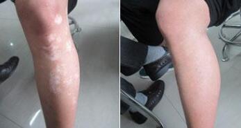 注重日常才能积极的摆脱白癜风!