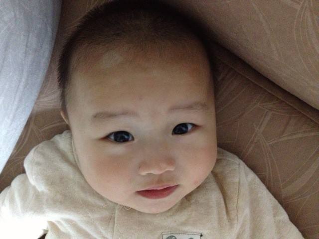 孩子在早期治疗白癜风好吗?