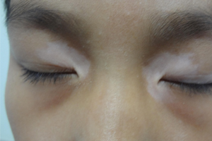 面部白癜风怎么治,短时间内能治好吗