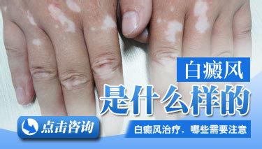 武汉能够治疗白癜风的医院