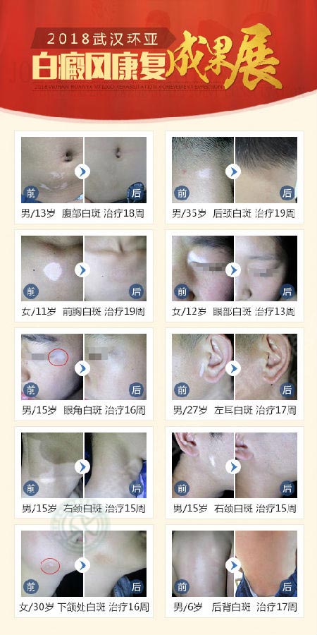 2018武汉环亚白癜风康复成果展暨沪鄂医生大型联合会诊