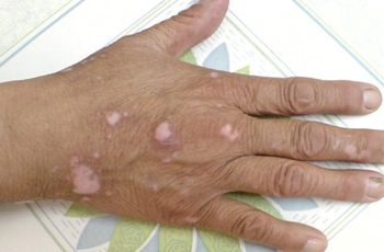 武汉白癜风患处开始发红是为什么?