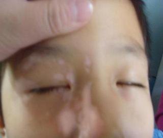 武汉儿童白癜风的预防要点是什么 武汉儿童白癜风的预防要点是什么