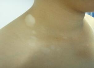 武汉关于白癜风预防治疗 武汉白癜风预防病情加重