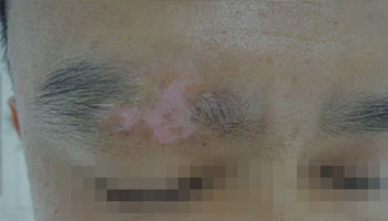 武汉关于白癜风到哪里治 武汉关于白癜风到哪里治