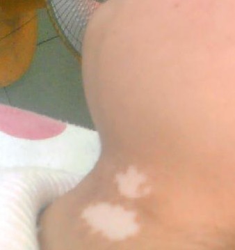 武汉孩子脸上长有白斑如何来治 武汉孩子脸上长有白斑如何来治