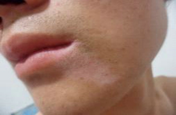 武汉儿童早期白癜风图片什么样 武汉儿童早期白癜风图片什么样