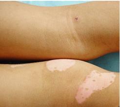 武汉儿童白癜风的预防很重要