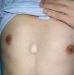 武汉白癜风治疗要多久时间 武汉哪里能治疗好白癜风