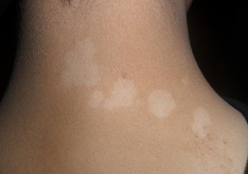 武汉如何治疗白癜风呢 武汉中医治疗白癜风的有效办法