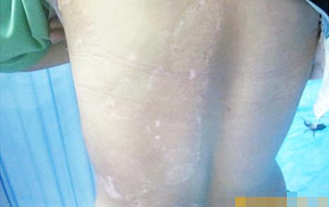 武汉白癜风能不能完全治好 武汉白癜风正规的治疗方式