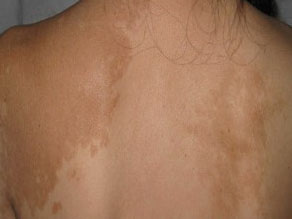 武汉白癜风要怎么治才能比较合适 武汉白癜风初期吃药会好吗