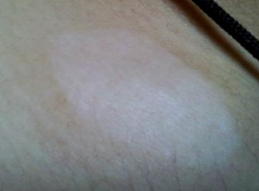 武汉白癜风治疗要花费多长的时间 武汉儿童白癜风可以治吗