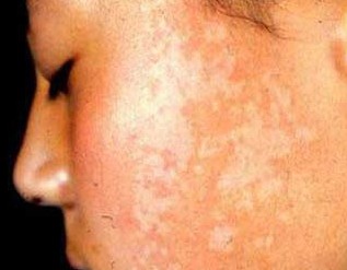 武汉白癜风哪治得好 武汉白斑一般患者是多久能治好