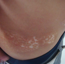 武汉临床上白癜风都有哪些症状呢 武汉治疗白癜风哪家医院效果好呢