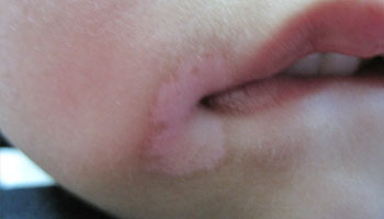 武汉发现自己患白癜风之后要及时治疗 武汉武汉面部出现白斑怎么办