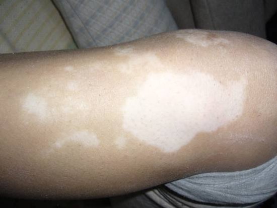 武汉小儿白癜风医治有哪些要求 武汉用偏方治疗白癜风能行的通吗