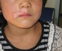 武汉儿童如何预防白癜风呢 武汉小孩子该如何预防白癜风出现呢