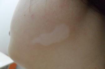 武汉怎样治疗白癜风又快又省 武汉白癜风早期会扩散吗