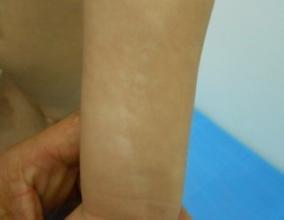 武汉白癜风医院位置 武汉白癜风医院